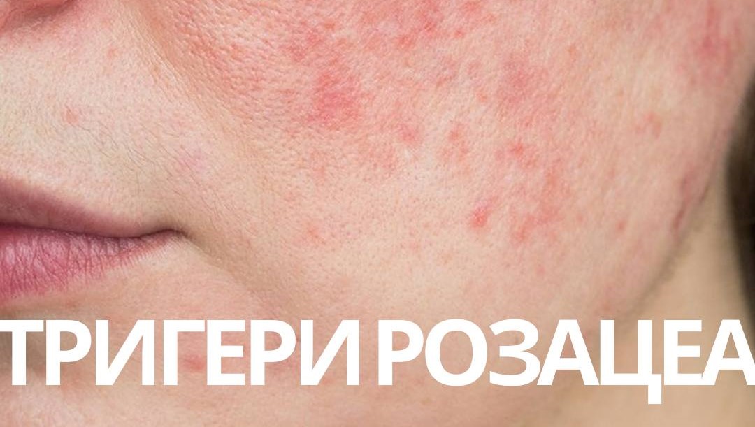 Rosacea Triggers: How to Avoid Flare-Ups