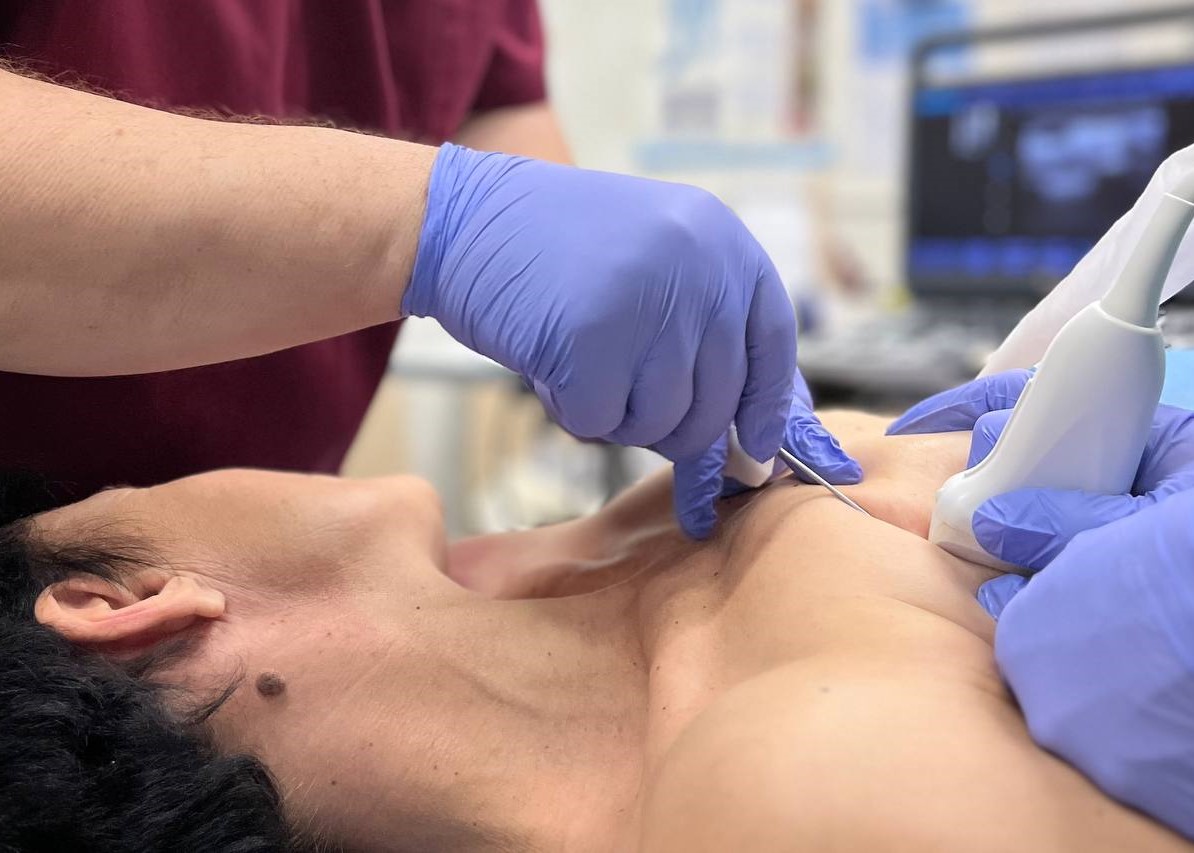 A BREAST CYST